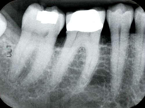 Digital-dental-periapical-xray.jpeg__PID:79052249-35ef-48f2-b45f-6612cb9932eb